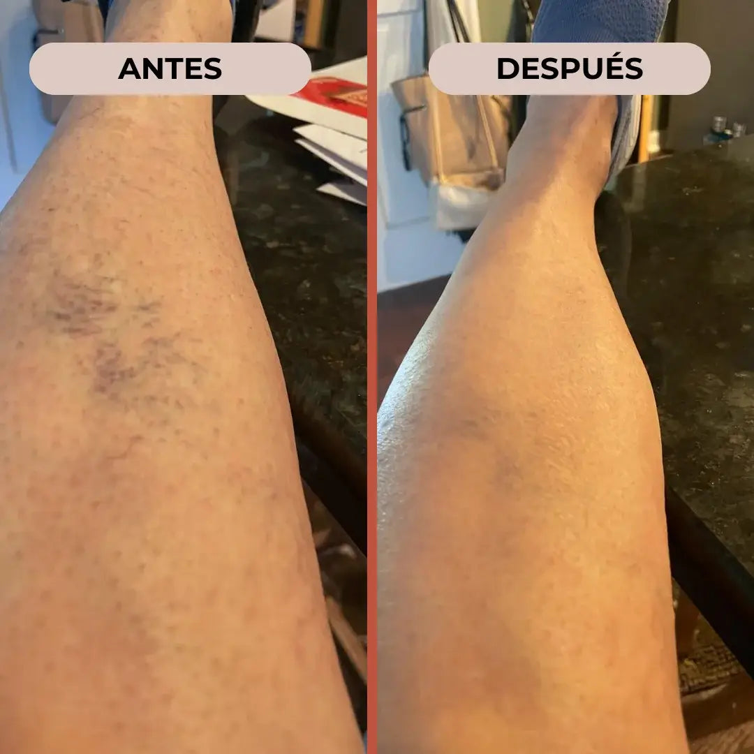 Circuvarice® | Piernas Ligeras, Confianza Instantánea
